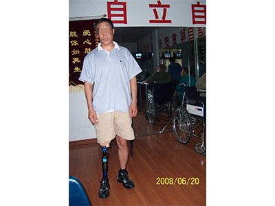 青島市遠征假肢矯形器 專業假肢與矯形器的選擇與服務