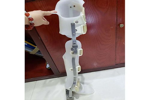 假肢與矯形器的使用周期與更換指南 科學維護，保障生活品質(zhì)